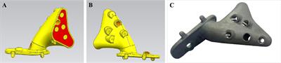 Reconstruction With 3D-Printed Prostheses After Sacroiliac Joint Tumor Resection: A Retrospective Case-Control Study